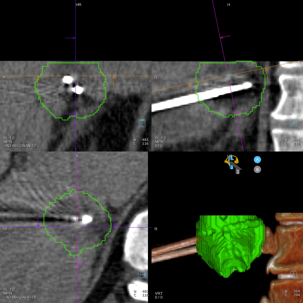 CT-guided cryoablation of a liver lesion shown in three planes and 3D reconstruction, with the planned ablation zone outlined in green